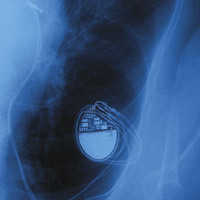 Herzschrittmacher im Röntgenbild